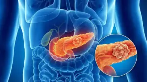 Illustrazione anatomica del pancreas con una massa evidenziata, con ingrandimento della lesione